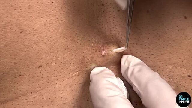 Стеатоцистомы (кисты с жидким содержимым) на теле