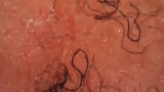 Моргеллоны в верхнем слое кожи.