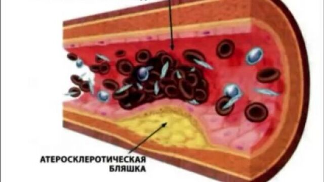 Мозговой кальций тяньши