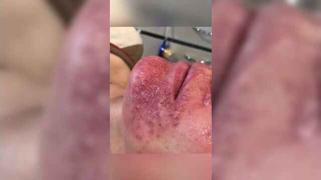 Пациент с розацеа.