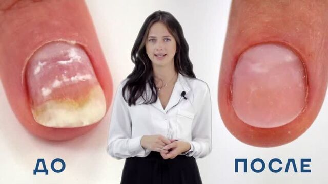 Онихолизис на руках