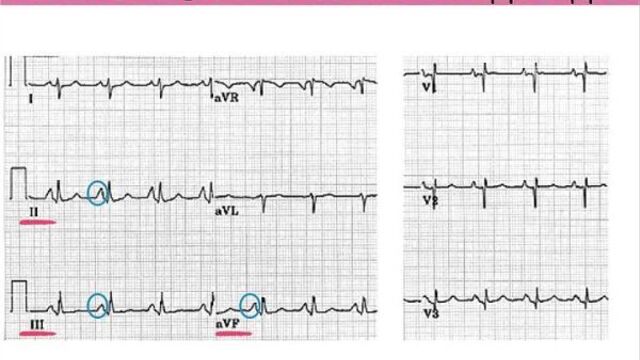 Расшифровка экг при гипертрофии предсердий - meduniver.com.mp4