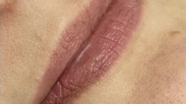 Контурная пластика губ. центр нео мед.